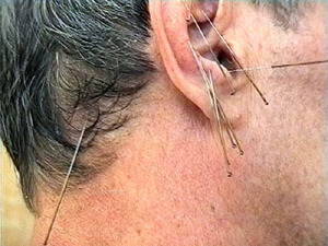 Многие считают, что иглоукалывание – это нетрадиционный…